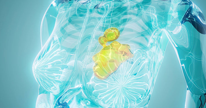 Breast Cancer Staging and Classification: What Patients Should Know