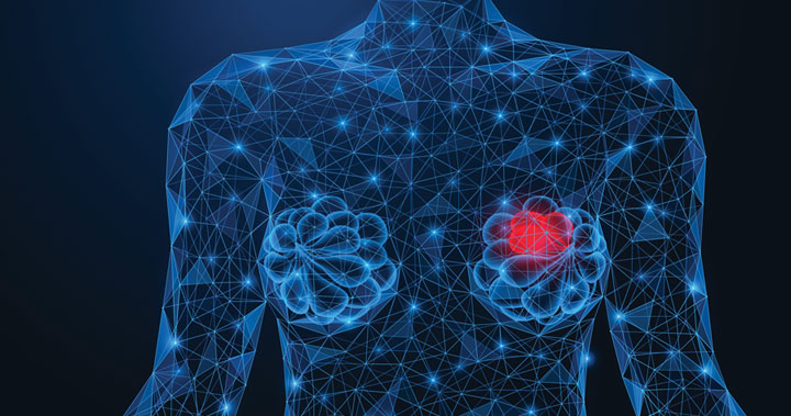 Breast Cancer Treatment: When Is Surgery Most Recommended?