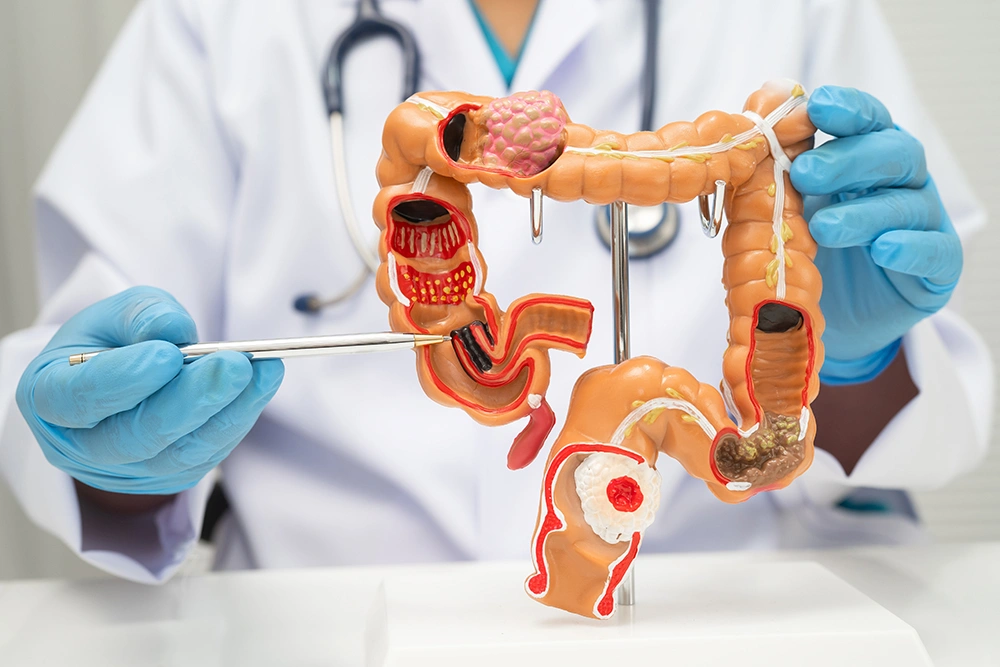 Doctor pointing to a model of the colon to explain colon cancer treatment