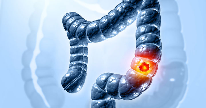 Colorectal Cancer: How Does Staging Influence Treatment?